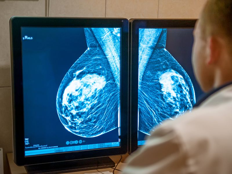 como o câncer aparece na mamografia
